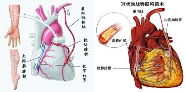 Introduction of special surgical instrument package for Xinhua bypass surgery(图1)