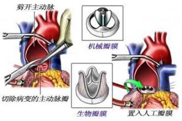 Introduction of special surgical instruments for replacement of new valve(图2)