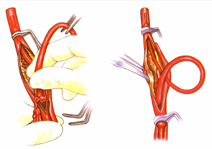 Introduction of special surgical instruments for carotid endarterectomy(图13)