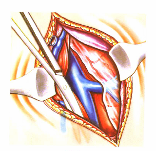Introduction of special surgical instruments for carotid endarterectomy(图3)