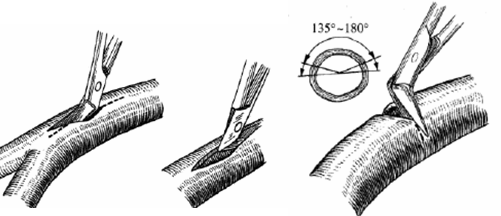 Introduction of special surgical instruments for carotid endarterectomy(图4)
