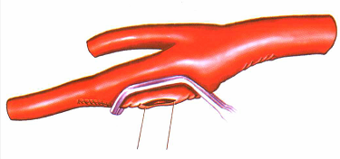 Introduction of special surgical instruments for carotid endarterectomy(图6)
