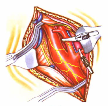 Introduction of special surgical instruments for carotid endarterectomy(图8)