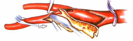 Introduction of special surgical instruments for carotid endarterectomy(图9)